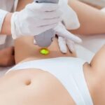 Laser và IPL là hai công nghệ phổ biến giúp giảm lông vùng bikini theo liệu trình. 