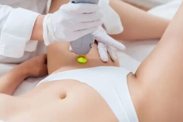 Laser và IPL là hai công nghệ phổ biến giúp giảm lông vùng bikini theo liệu trình. 