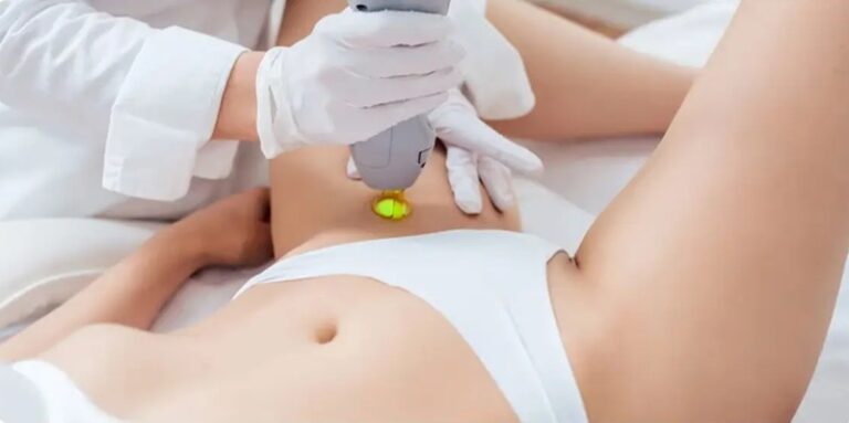 Laser và IPL là hai công nghệ phổ biến giúp giảm lông vùng bikini theo liệu trình. 