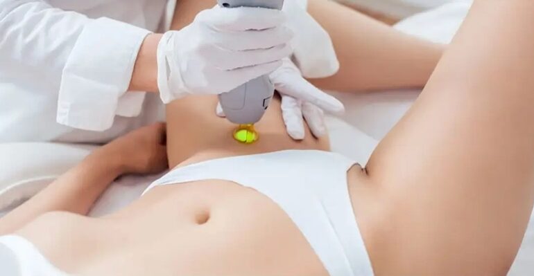 Laser và IPL là hai công nghệ phổ biến giúp giảm lông vùng bikini theo liệu trình. 