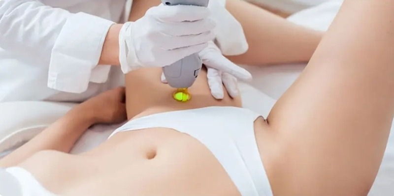 Laser và IPL là hai công nghệ phổ biến giúp giảm lông vùng bikini theo liệu trình.