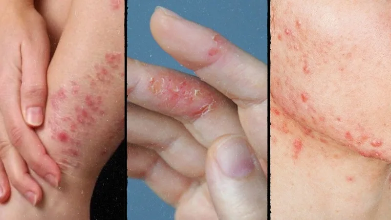 Tay chân miệng có thể gây loét miệng, ban đỏ hoặc bóng nước tại lòng bàn tay và bàn chân.
