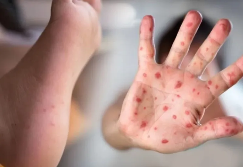 Virus tay chân miệng có thể lan qua dịch tiết, dịch bóng nước, phân và các bề mặt bị nhiễm bẩn.